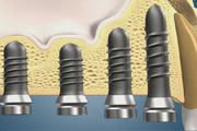 Bone Condesation and Internal Sinus Lift-Straumann